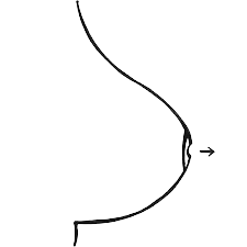 Nipple inversion (inside out nipple)